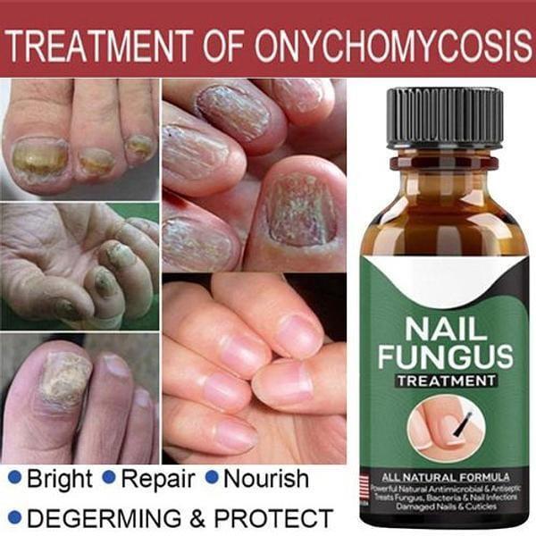 Fast Nail Fungal Treatments Nail Repair