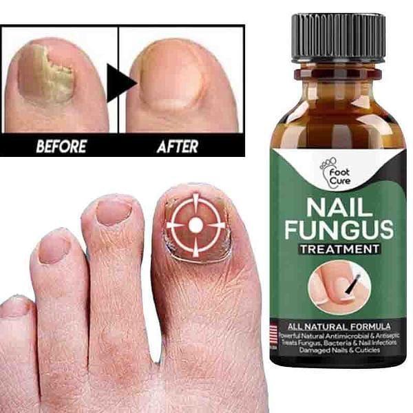 Fast Nail Fungal Treatments Nail Repair