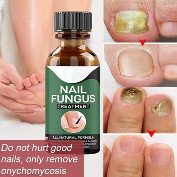 Fast Nail Fungal Treatments Nail Repair